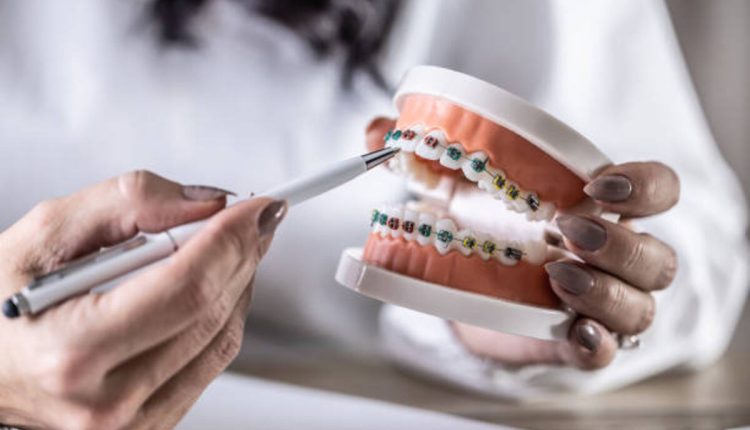 dental implants in Los Gatos CA