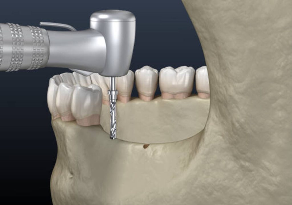 penile implant cost in dubai