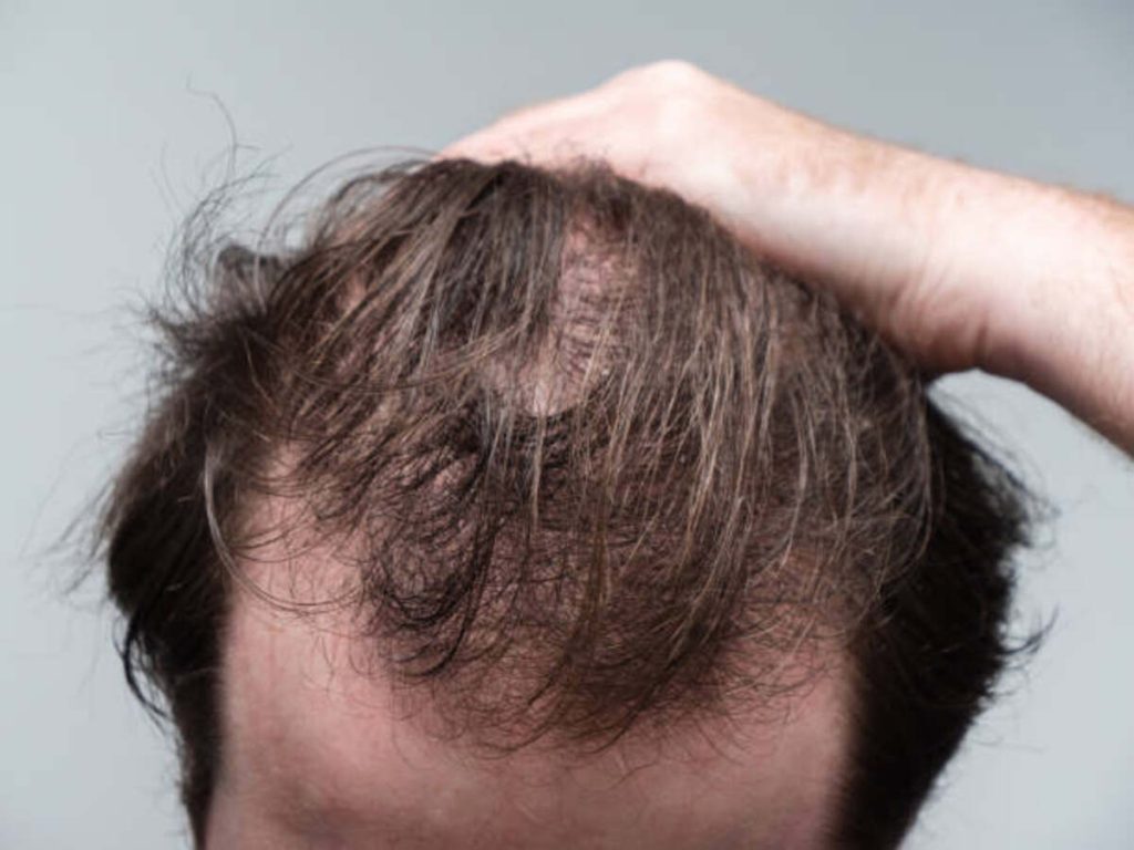PRP for hair loss