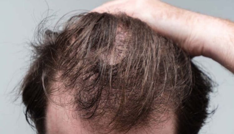 PRP for hair loss