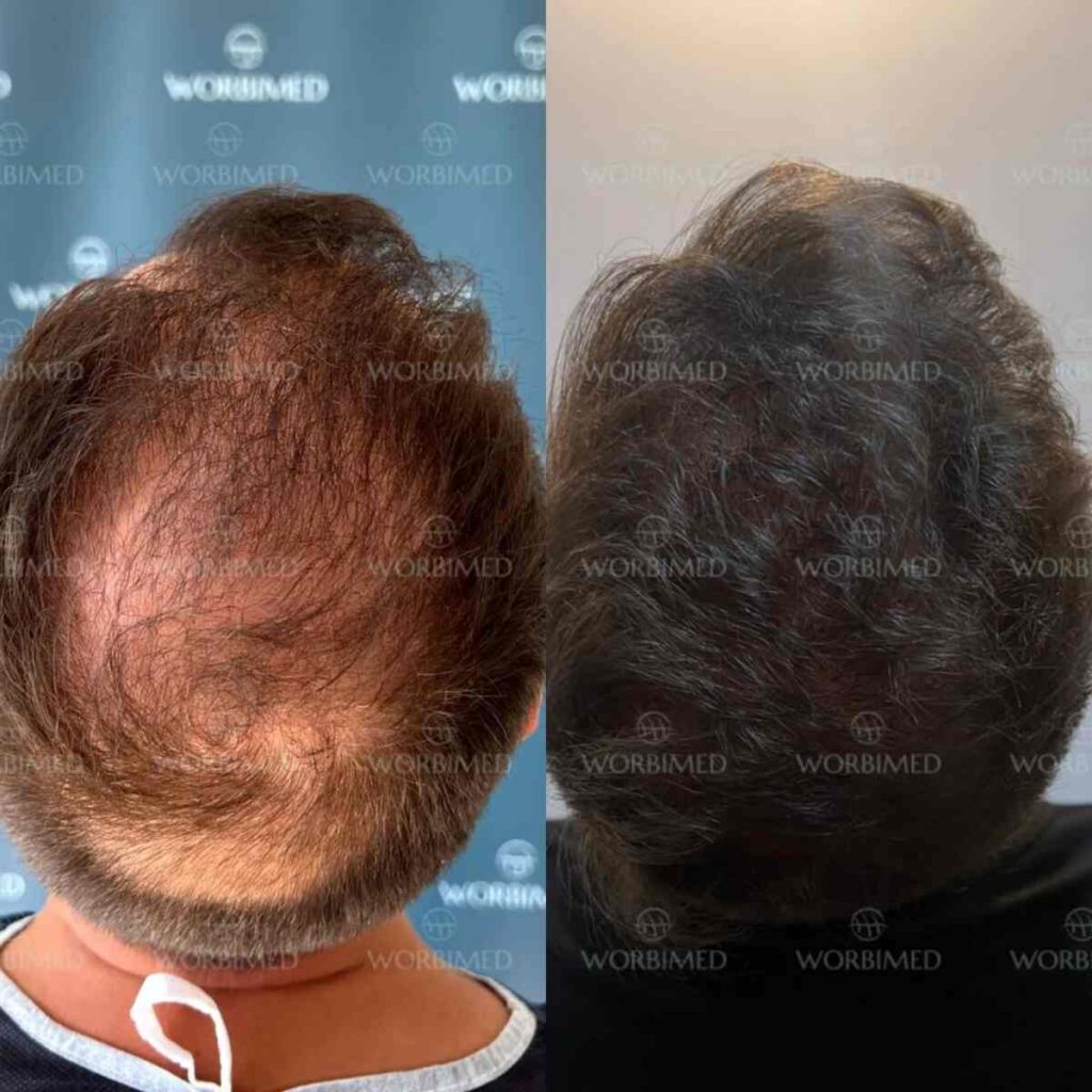 Beard transplant