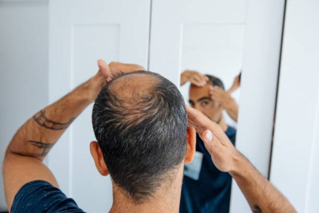 PRP For Hair Loss (1)