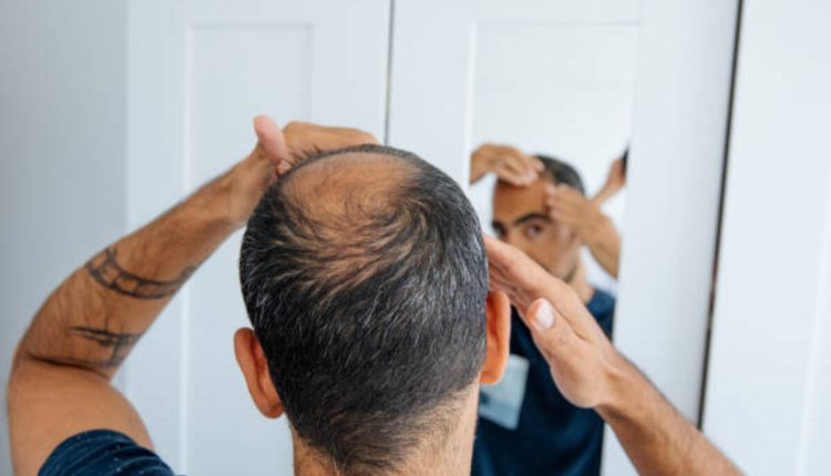 PRP For Hair Loss (1)