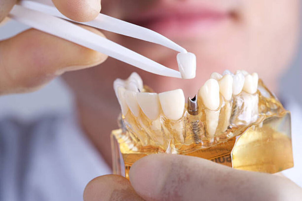 Top Best Dental Implant Companies