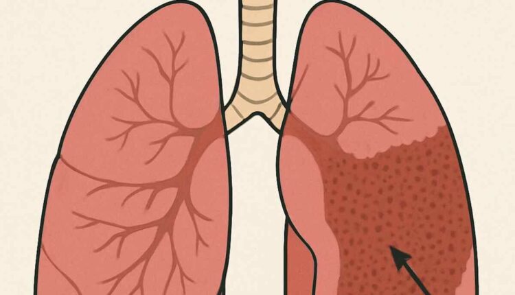 asbestosis compensation